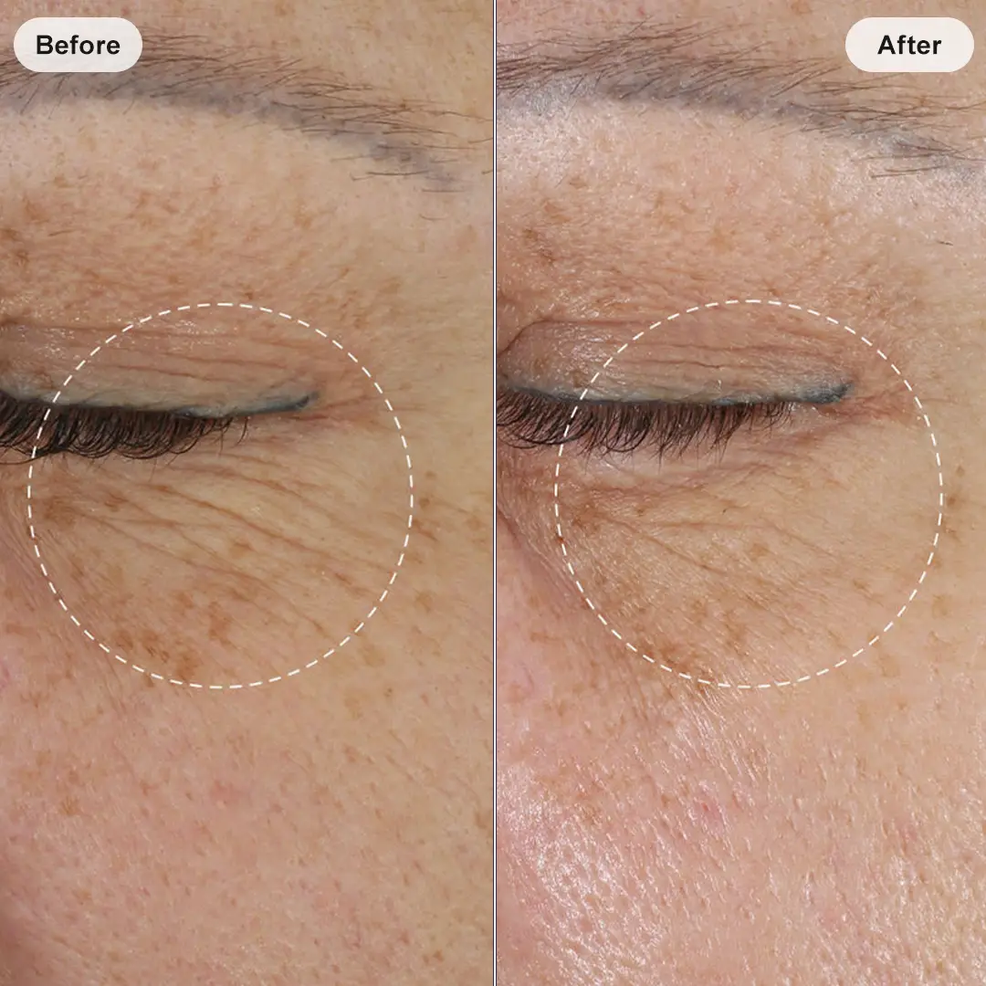 improvement in the appearance of fine lines