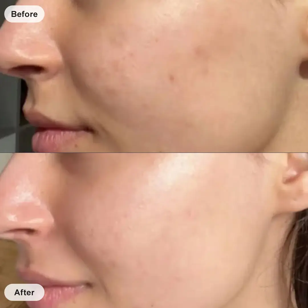 87% saw fewer visible blemishes